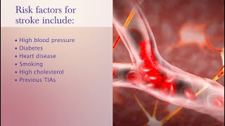 Who is at Risk for Stroke?